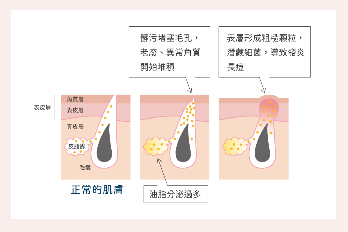 背部痘痘形成過程。油脂分泌過多，導致毛孔容易阻塞堆積。