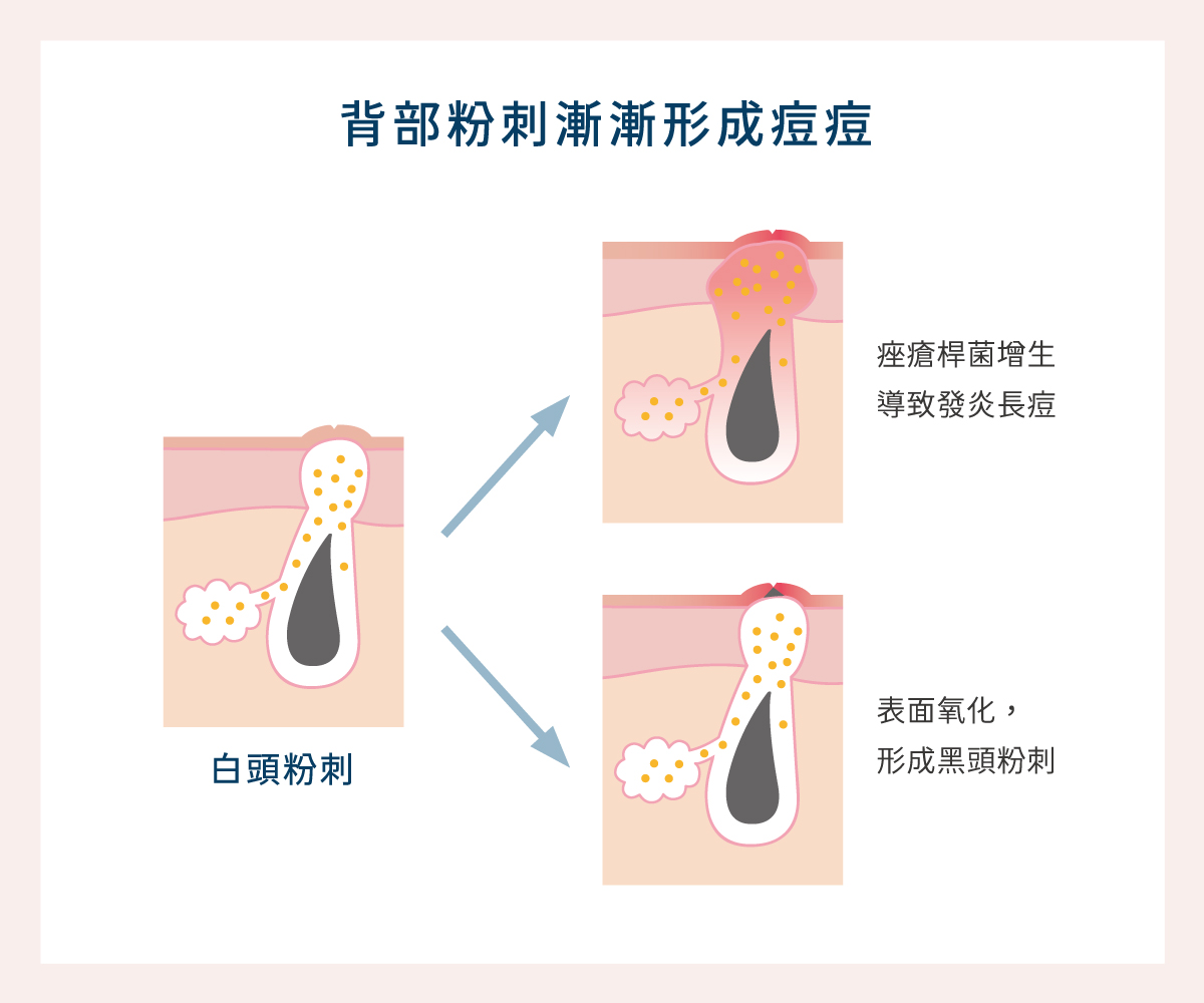 白頭粉刺演化成大痘痘或是黑頭粉刺。